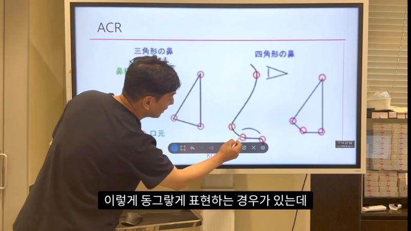 코 수술로 돌출입수술 효과를 얻을 수 있습니다! - 1편 사진 11