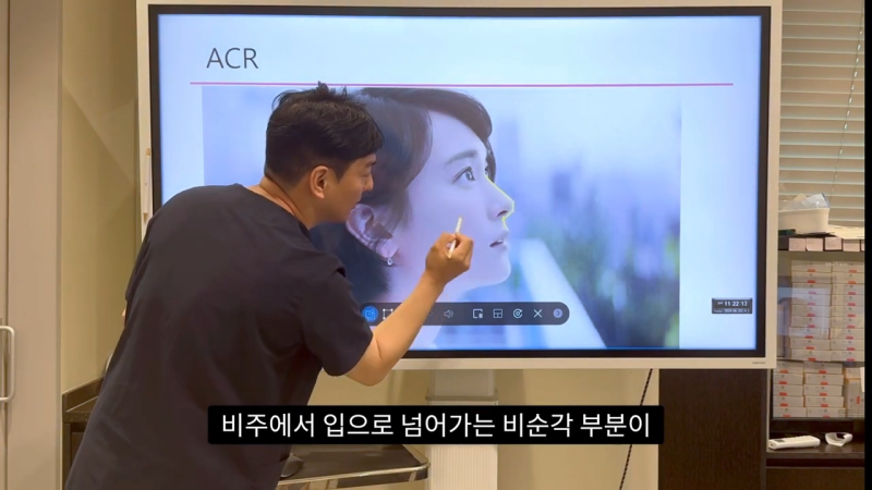 코 수술로 돌출입수술 효과를 얻을 수 있습니다! - 1편 사진 15