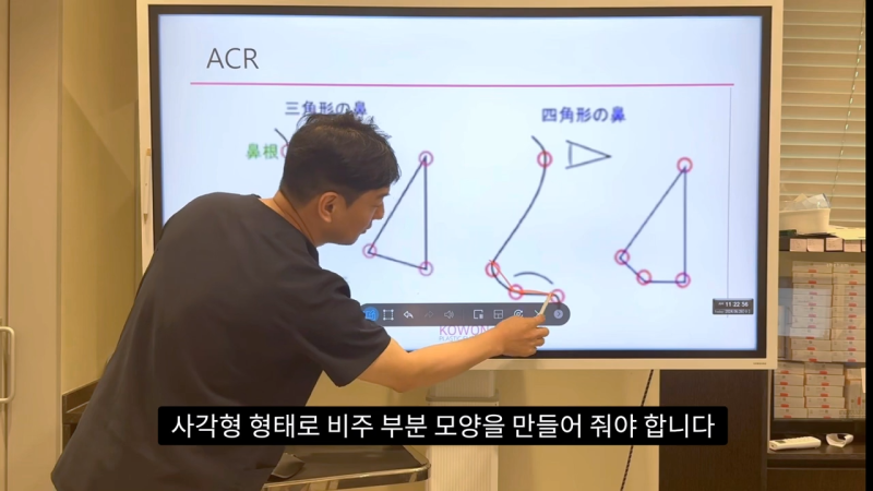 코 수술로 돌출입수술 효과를 얻을 수 있습니다! - 1편 사진 20