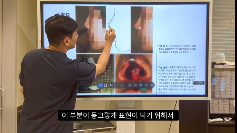 코 수술로 돌출입수술 효과를 얻을 수 있습니다! - 1편 사진 21