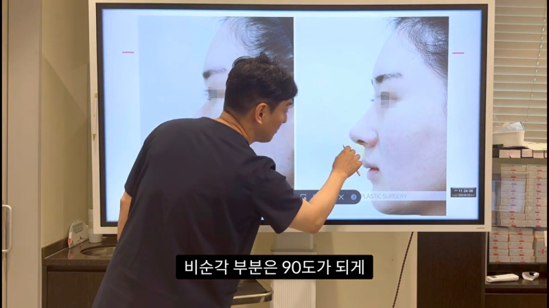 코 수술로 돌출입수술 효과를 얻을 수 있습니다! - 1편 사진 34