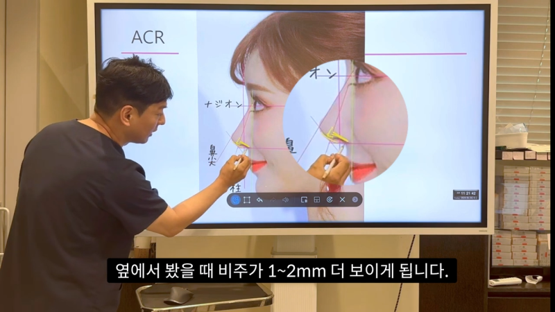 코 수술로 돌출입수술 효과를 얻을 수 있습니다! - 1편 사진 9