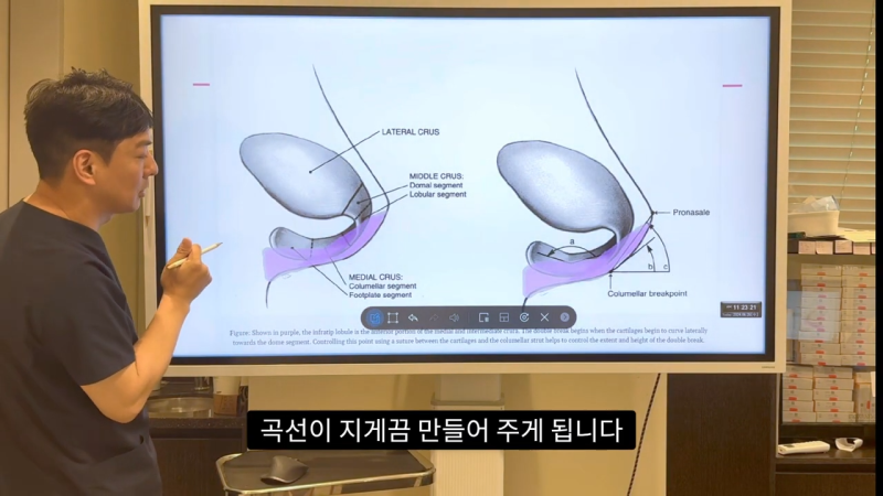 코 수술로 돌출입수술 효과를 얻을 수 있습니다! - 1편 사진 25