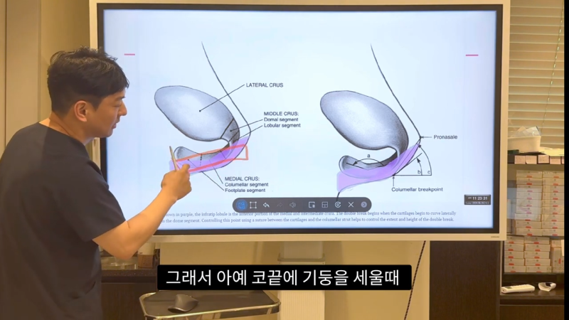 코 수술로 돌출입수술 효과를 얻을 수 있습니다! - 1편 사진 27