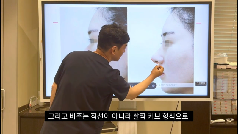코 수술로 돌출입수술 효과를 얻을 수 있습니다! - 1편 사진 33