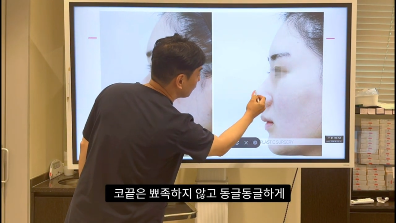 코 수술로 돌출입수술 효과를 얻을 수 있습니다! - 1편 사진 32