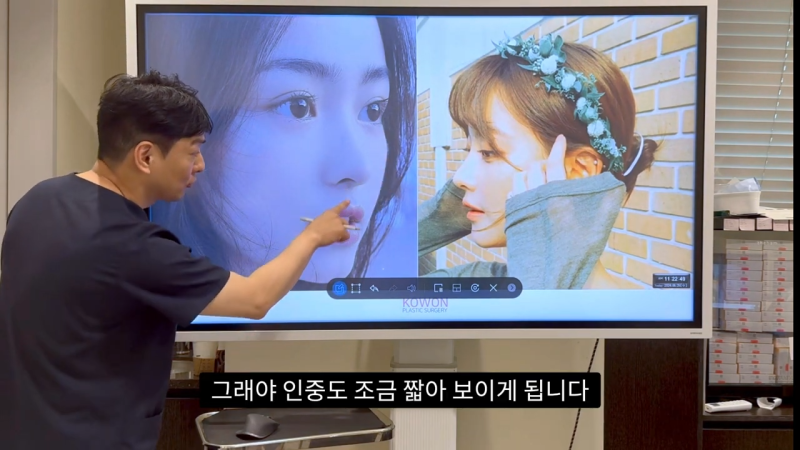 코 수술로 돌출입수술 효과를 얻을 수 있습니다! - 1편 사진 19