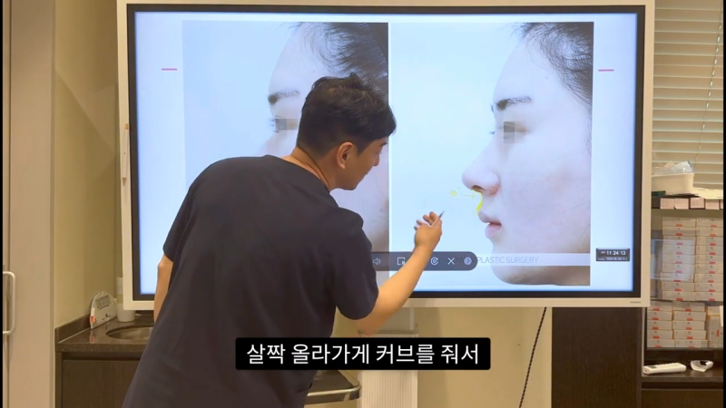 코 수술로 돌출입수술 효과를 얻을 수 있습니다! - 1편 사진 35