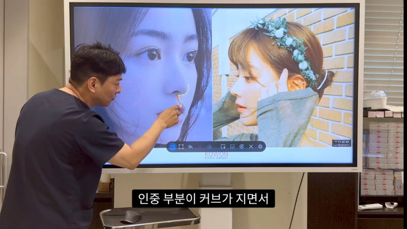 코 수술로 돌출입수술 효과를 얻을 수 있습니다! - 1편 사진 17