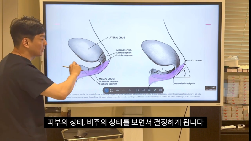 코 수술로 돌출입수술 효과를 얻을 수 있습니다! - 1편 사진 29
