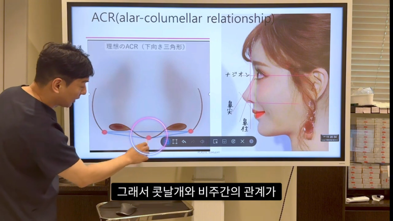 코 수술로 돌출입수술 효과를 얻을 수 있습니다! - 1편 사진 4