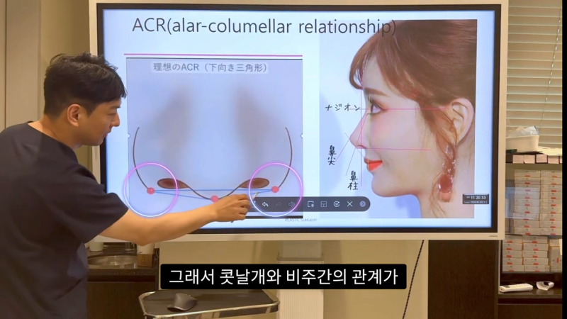 코 수술로 돌출입수술 효과를 얻을 수 있습니다! - 1편 사진 5