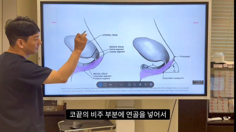코 수술로 돌출입수술 효과를 얻을 수 있습니다! - 1편 사진 24