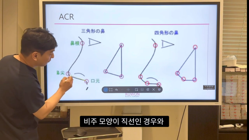 코 수술로 돌출입수술 효과를 얻을 수 있습니다! - 1편 사진 10