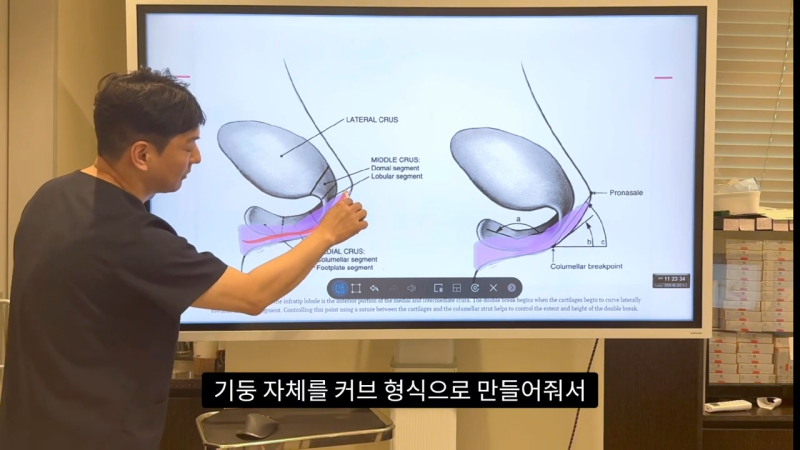 코 수술로 돌출입수술 효과를 얻을 수 있습니다! - 1편 사진 28