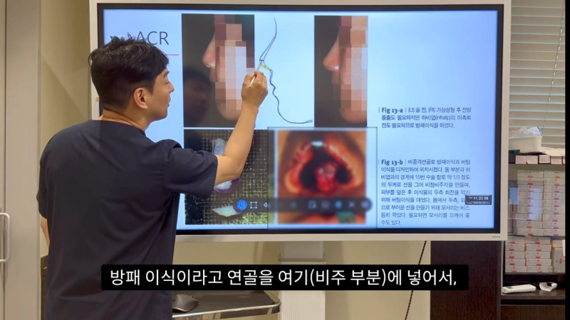 코 수술로 돌출입수술 효과를 얻을 수 있습니다! - 1편 사진 22