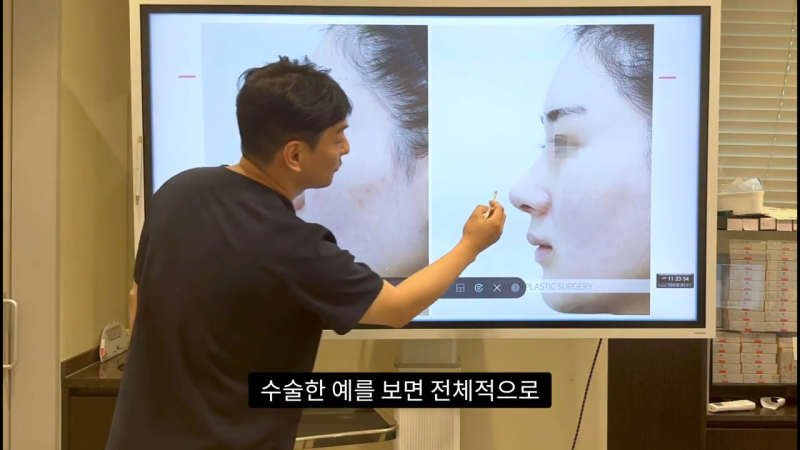코 수술로 돌출입수술 효과를 얻을 수 있습니다! - 1편 사진 31