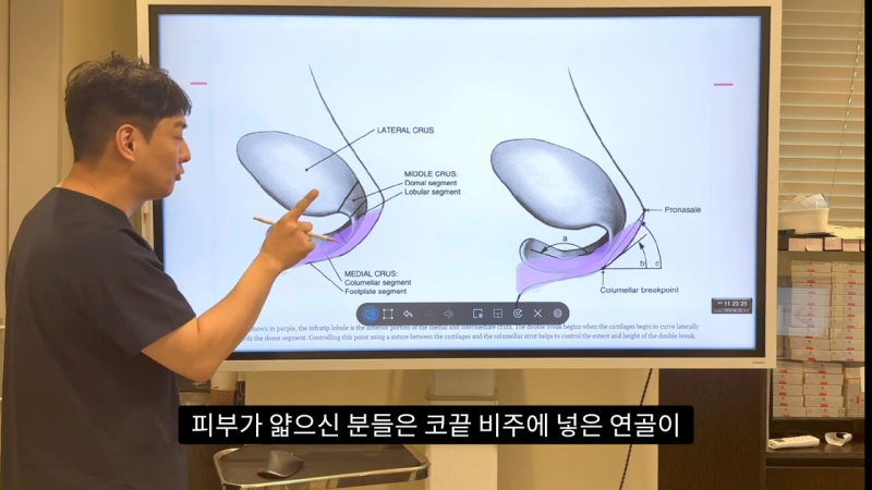 코 수술로 돌출입수술 효과를 얻을 수 있습니다! - 1편 사진 26