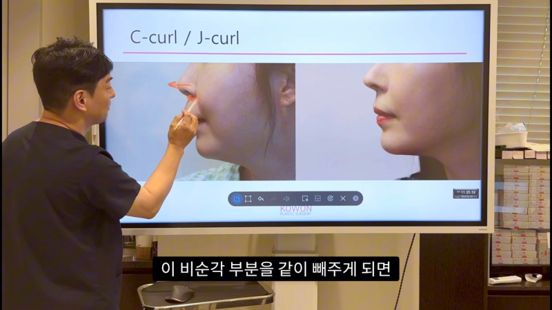 코 수술로 돌출입교정효과를 얻을 수 있습니다! - 2편 사진 9