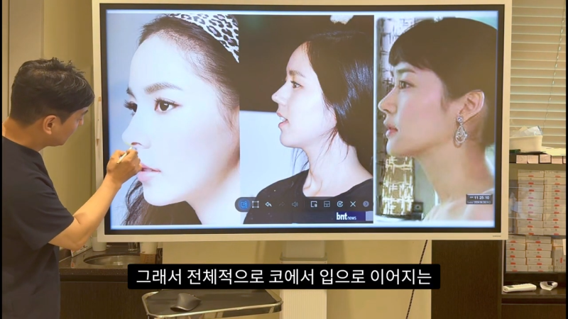 코 수술로 돌출입교정효과를 얻을 수 있습니다! - 2편 사진 4