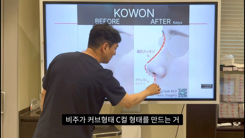 코 수술로 돌출입교정효과를 얻을 수 있습니다! - 2편 사진 18