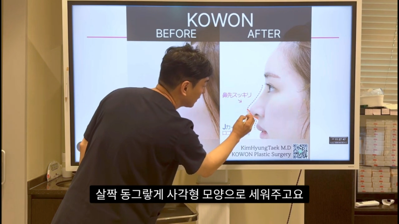 코 수술로 돌출입교정효과를 얻을 수 있습니다! - 2편 사진 20