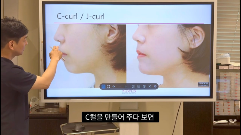 코 수술로 돌출입교정효과를 얻을 수 있습니다! - 2편 사진 12