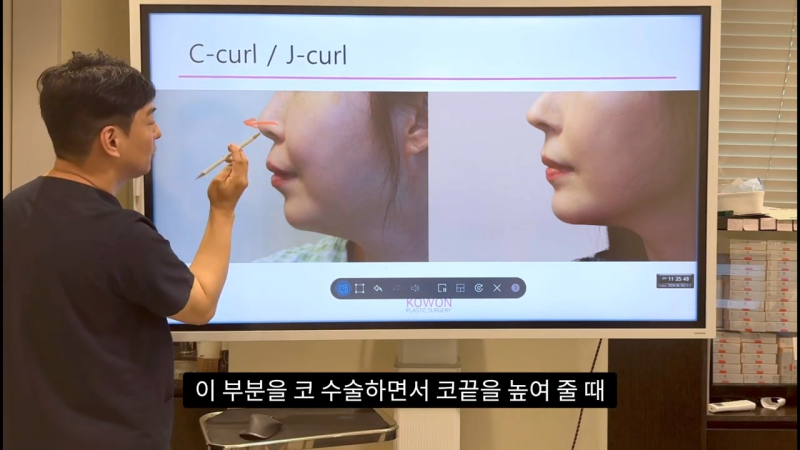 코 수술로 돌출입교정효과를 얻을 수 있습니다! - 2편 사진 8