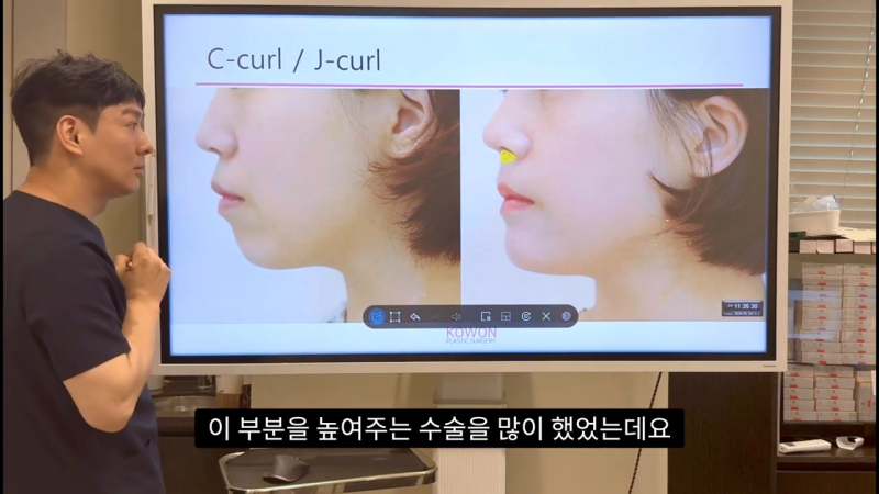 코 수술로 돌출입교정효과를 얻을 수 있습니다! - 2편 사진 14