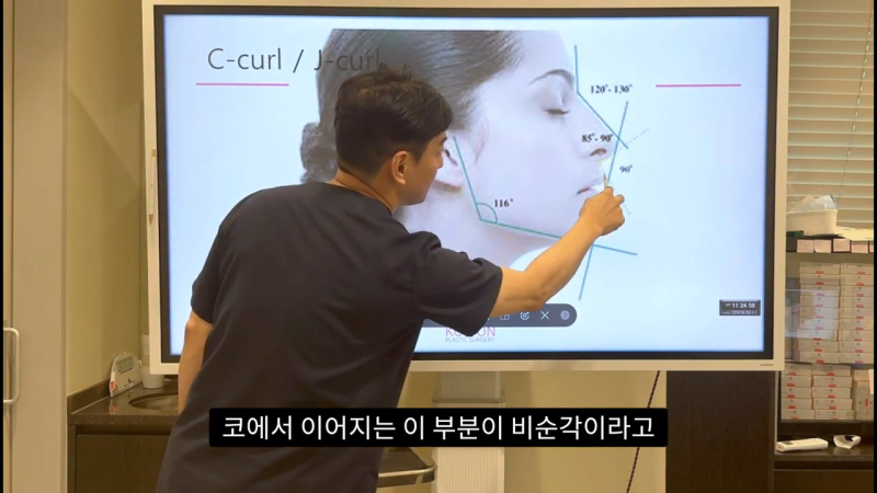 코 수술로 돌출입교정효과를 얻을 수 있습니다! - 2편