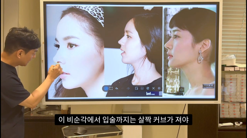 코 수술로 돌출입교정효과를 얻을 수 있습니다! - 2편 사진 5