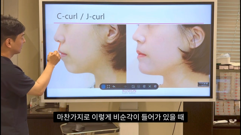 코 수술로 돌출입교정효과를 얻을 수 있습니다! - 2편 사진 11