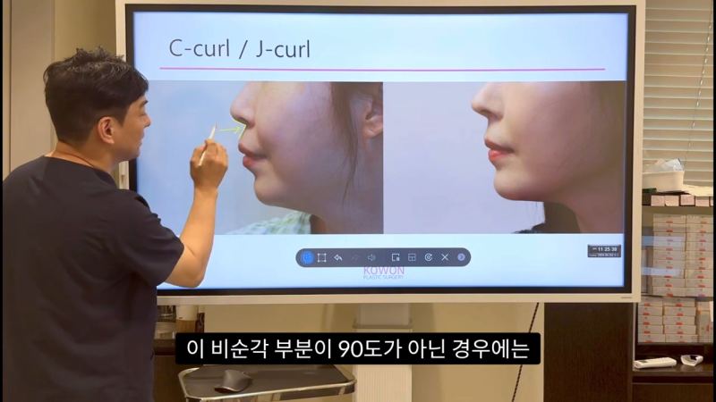 코 수술로 돌출입교정효과를 얻을 수 있습니다! - 2편 사진 6
