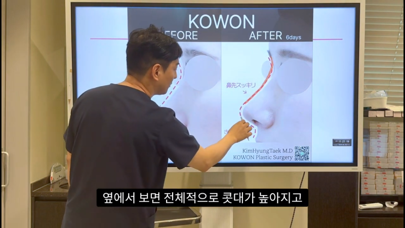 코 수술로 돌출입교정효과를 얻을 수 있습니다! - 2편 사진 17