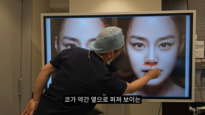돌출입코성형, 비순각 각도와 비주내리기 수술의 관계성 - 1편 사진 18