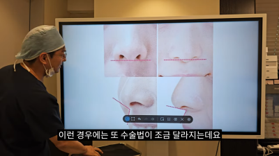 돌출입코성형, 비순각 각도와 비주내리기 수술의 관계성 - 1편 사진 27