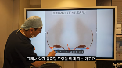 돌출입코성형, 비순각 각도와 비주내리기 수술의 관계성 - 1편 사진 12