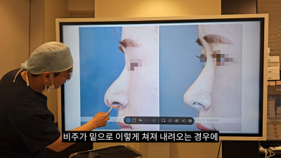 돌출입코성형, 비순각 각도와 비주내리기 수술의 관계성 - 1편 사진 28