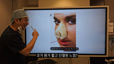 돌출입코성형, 비순각 각도와 비주내리기 수술의 관계성 - 1편 사진 19