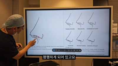 돌출입코성형, 비순각 각도와 비주내리기 수술의 관계성 - 1편 사진 5