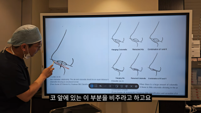 돌출입코성형, 비순각 각도와 비주내리기 수술의 관계성 - 1편 사진 3