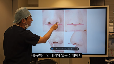 돌출입코성형, 비순각 각도와 비주내리기 수술의 관계성 - 1편 사진 10