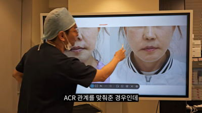 돌출입코성형, 비순각 각도와 비주내리기 수술의 관계성 - 1편 사진 22