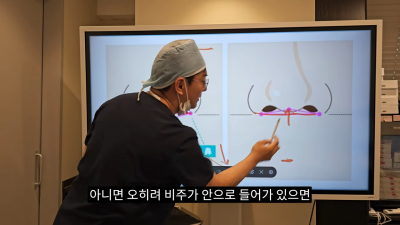 돌출입코성형, 비순각 각도와 비주내리기 수술의 관계성 - 1편 사진 14