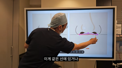 돌출입코성형, 비순각 각도와 비주내리기 수술의 관계성 - 1편 사진 13