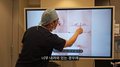 돌출입코성형, 비순각 각도와 비주내리기 수술의 관계성 - 1편 사진 9