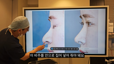돌출입코성형, 비순각 각도와 비주내리기 수술의 관계성 - 1편 사진 29