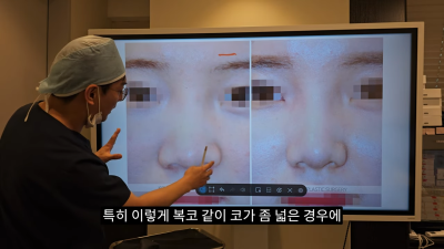 돌출입코성형, 비순각 각도와 비주내리기 수술의 관계성 - 1편 사진 24