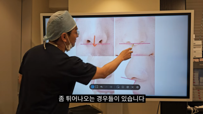 돌출입코성형, 비순각 각도와 비주내리기 수술의 관계성 - 1편 사진 26