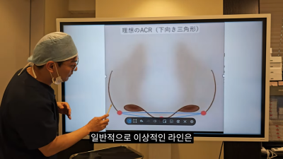 돌출입코성형, 비순각 각도와 비주내리기 수술의 관계성 - 1편 사진 11